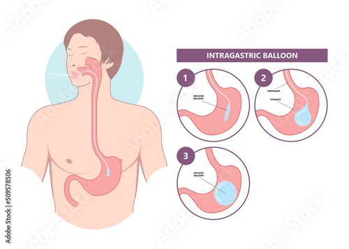 Gastric bypass surgery and Band roux en y procedure endoscopy weight loss hiatal hernia diet food full body mass index or BMI reflux GERD eat obese clinic tummy tuck small lap sleep apnea high blood