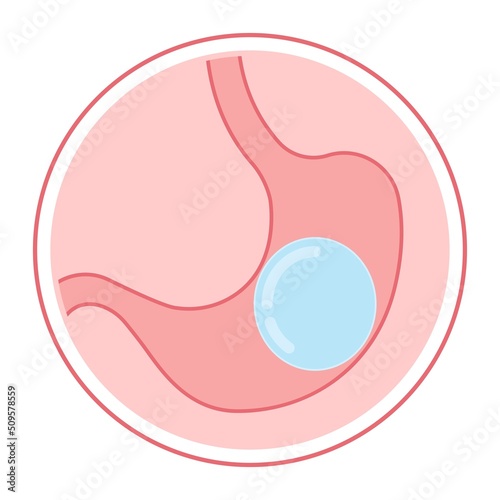 Gastric bypass surgery and Band roux en y procedure endoscopy weight loss hiatal hernia diet food full body mass index or BMI reflux GERD eat obese clinic tummy tuck small lap sleep apnea high blood