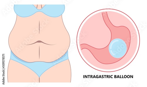 Gastric bypass surgery and Band roux en y procedure endoscopy weight loss hiatal hernia diet food full body mass index or BMI reflux GERD eat obese clinic tummy tuck small lap sleep apnea high blood