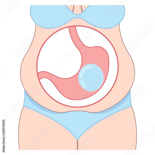Gastric bypass surgery and Band roux en y procedure endoscopy weight loss hiatal hernia diet food full body mass index or BMI reflux GERD eat obese clinic tummy tuck small lap sleep apnea high blood
