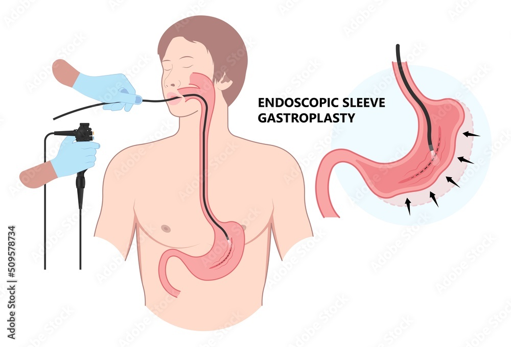 Gastric bypass surgery and Band roux en y procedure endoscopy weight