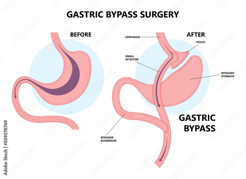 Vecteur Stock Gastric bypass surgery and Band roux en y procedure