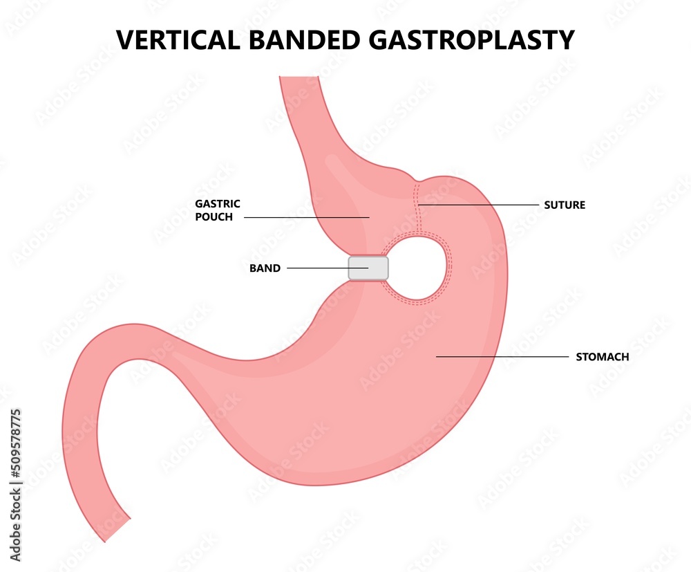Gastric bypass surgery and Band roux en y procedure endoscopy weight