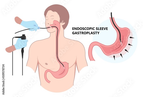 Gastric bypass surgery and Band roux en y procedure endoscopy weight loss hiatal hernia diet food full body mass index or BMI reflux GERD eat obese clinic tummy tuck small lap sleep apnea high blood