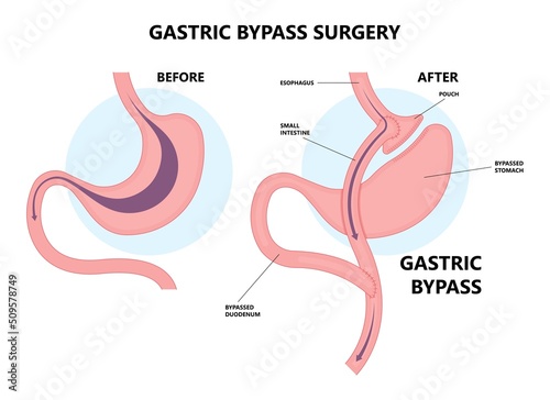 Gastric bypass surgery and Band roux en y procedure endoscopy weight loss hiatal hernia diet food full body mass index or BMI reflux GERD eat obese clinic tummy tuck small lap sleep apnea high blood