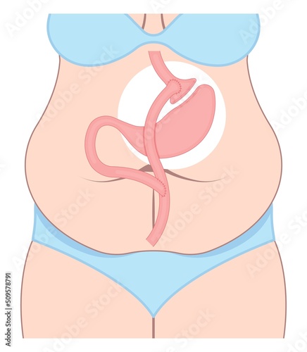 Gastric bypass surgery and Band roux en y procedure endoscopy weight loss hiatal hernia diet food full body mass index or BMI reflux GERD eat obese clinic tummy tuck small lap sleep apnea high blood photo