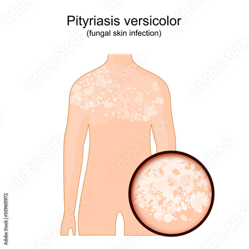 Tinea versicolor. Human body with symptoms of pityriasis versicolor. photo