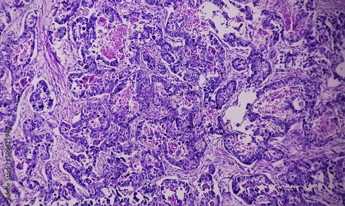 Stomach cancer: Adenocarcinoma of stomach, antrum cancer. High grade acute Inflammation near the tumor nests. Microscopic view. photo