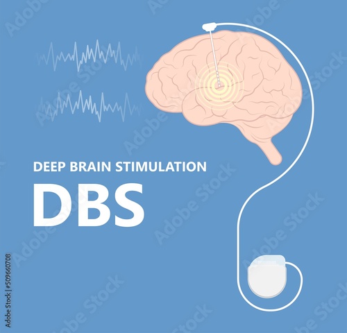 Deep brain stimulation or DBS treat Parkinson's disease PD and TMS condition major neural stimulator pulse neurological wave implanted Motor bipolar
