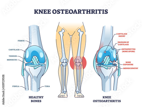 Knee osteoarthritis condition with skeletal bone degeneration outline diagram. Labeled educational scheme with medical orthopedic disease vector illustration. Injury comparison with healthy leg bones. photo