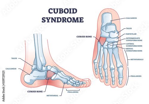 Cuboid syndrome as orthopedic trauma after foot torn injury outline diagram. Labeled educational scheme with feet bone dislocation and free movement vector illustration. Cuboid subluxation problem. photo