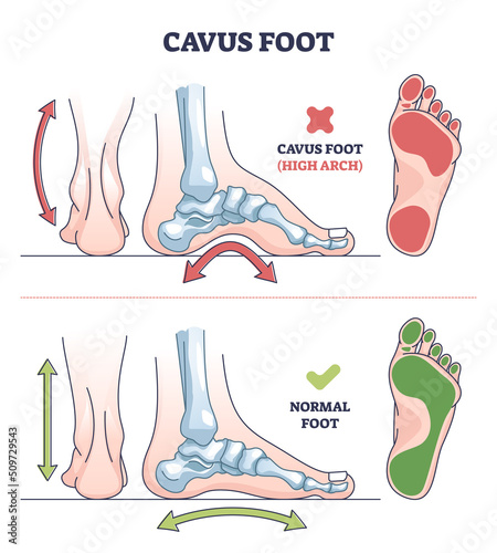 Cavus foot with abnormal high arch condition to feet bones outline diagram. Labeled educational medical deformation compared with healthy model vector illustration. Orthopedic skeletal pathology.