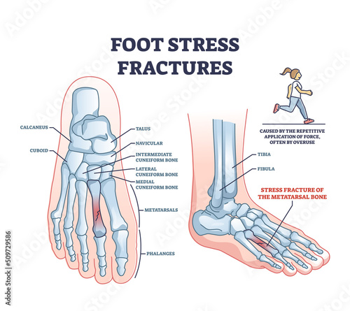 Foot stress fractures as bone cracking trauma or injury outline diagram. Labeled educational scheme with leg skeletal anatomy and orthopedic problem caused by repetitive overuse vector illustration.