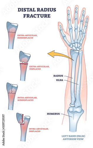 Canvas Print Distal radius fracture and broken arm bone types anatomy outline diagram