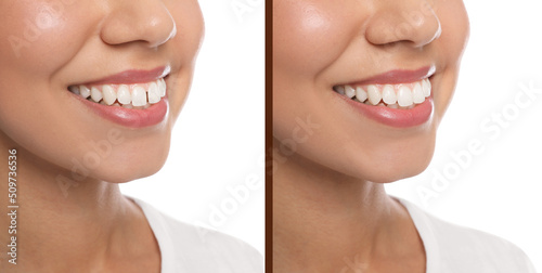 Collage with photos of woman with diastema between upper front teeth before and after treatment on white background, closeup. Banner design photo