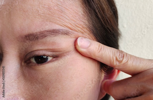 Portrait showing the fingers touching the flabbiness adipose hanging beside the eyelid, problem wrinkle and flabby skin on the face of the woman, concept health care.