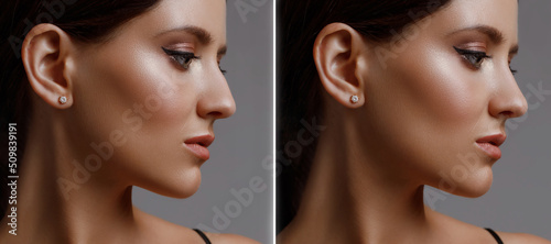 Fotografie rhinoplasty before and after correction, young girl in profile