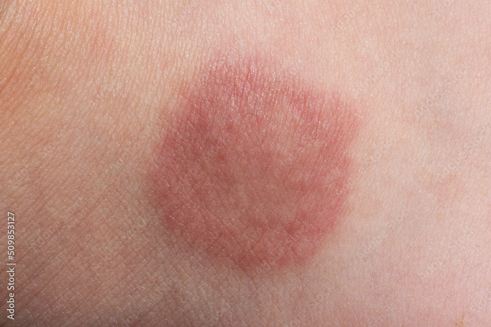 Fototapeta premium lichen on human skin close-up