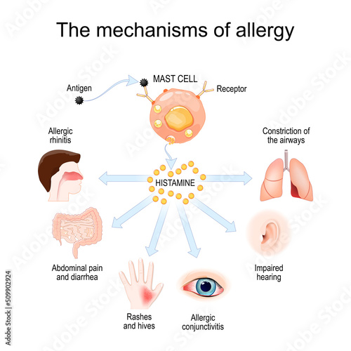 Mechanism of allergy. Mast cells and allergic reaction. Histamine.