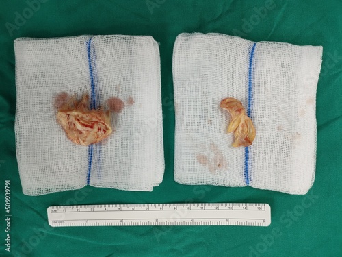 The native mitral valve was removed from patient who diagnosed rheumatic heart disease with mitral stenosis during Mitral valve replacement that is open heart surgery. There is a ruler for scale. photo