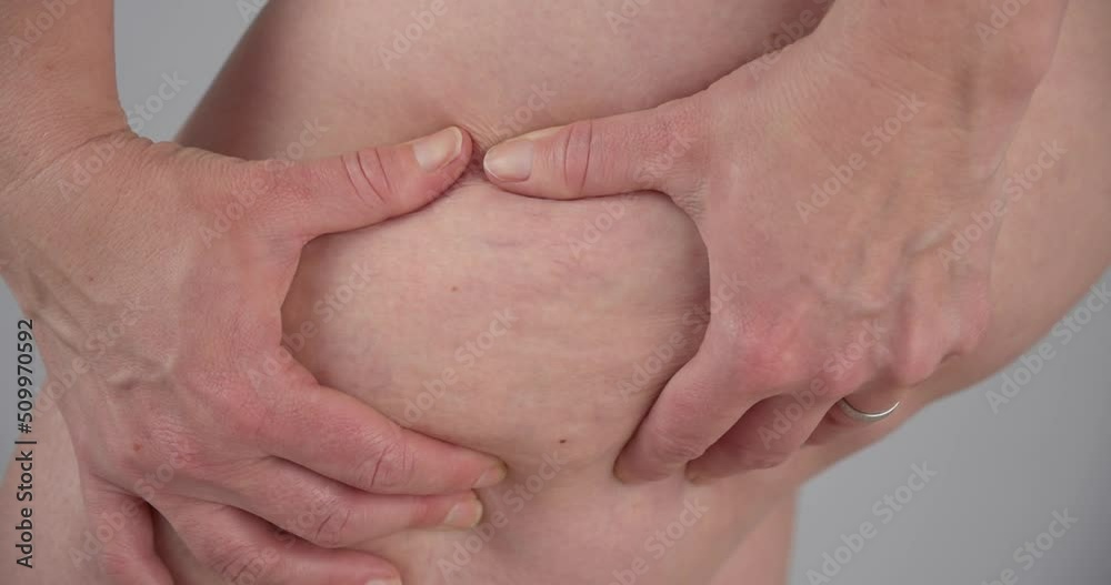 Cellulitis Problem on Young Woman's Body, Hands Squeeze Cellulite in Closeup Cellulitis Problem on Young Woman's Body, Hands Squeeze Cellulite in Closeup