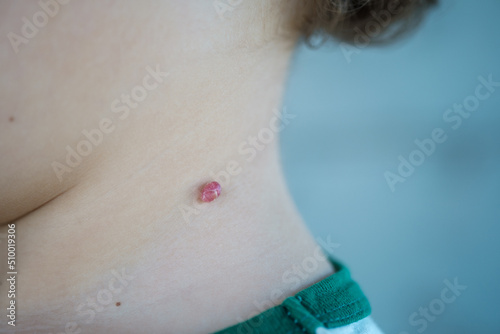 hemangioma on the neck of a child photo