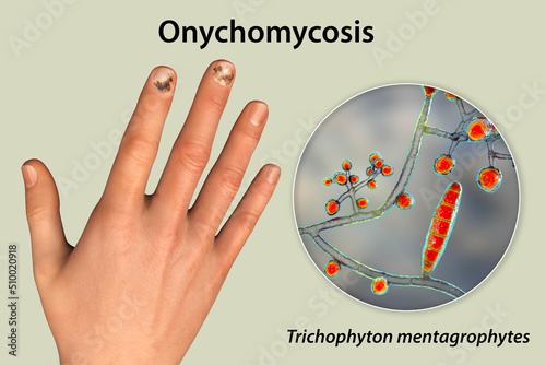Human hand with onychomycosis photo