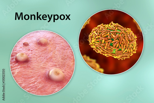 Skin lesions in monkeypox infection, 3D illustration