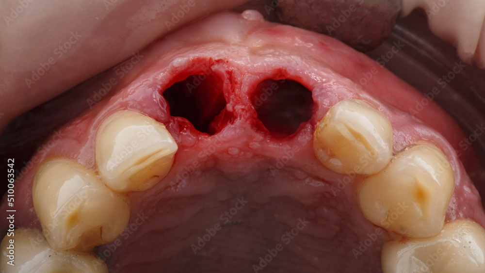 two removed central teeth before implantation view through the mirror