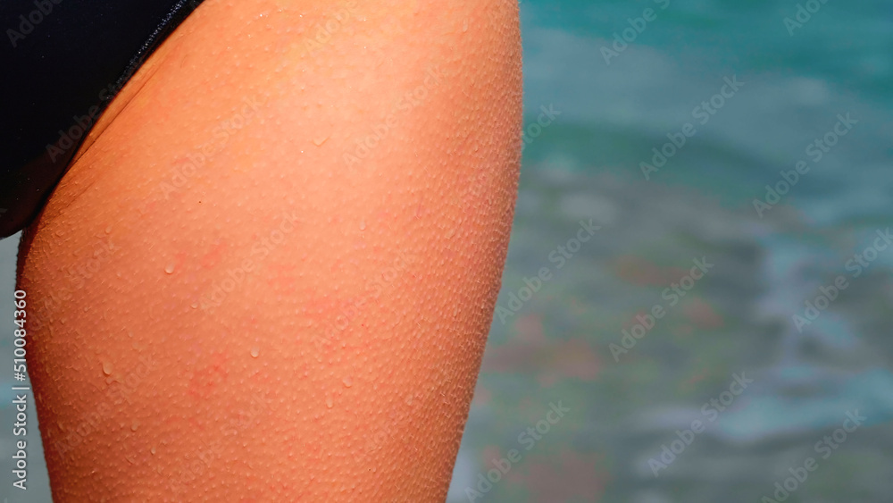 Caucasian woman having chills on skin on cold and windy summer day. Goosebumps on on a woman thighs on freezing day at seashore. Close up skin. - obrazy, fototapety, plakaty 