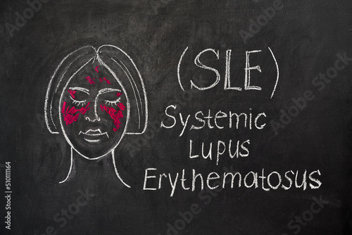 Systemic lupus erythematosus (SLE), is the most common type of lupus. Illustration on a chalkboard photo