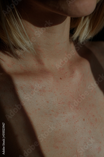 Allergic Reaction On Skin Of Body Close-up photo