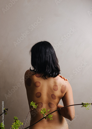 Bare back covered in cupping marks photo