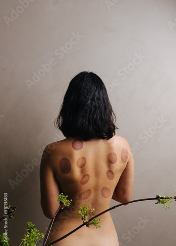 Bare back covered in cupping marks photo