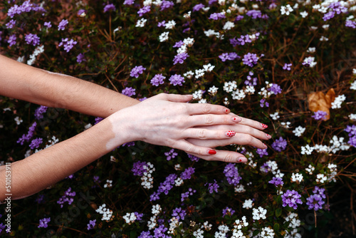 Hands with vitiligo over flowers photo