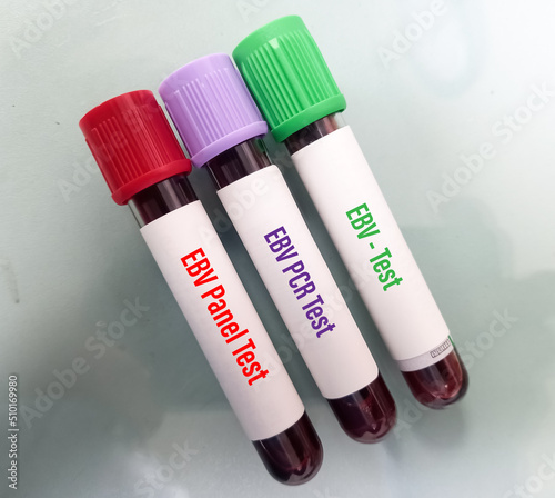 Blood test samples for EBV (Epstein-Barr virus) panel test, EBV PCR test, EBV test, to help diagnose EBV infection. photo