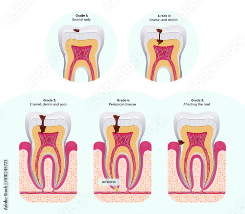 Disease of the tooth. Caries. Stages of development of caries