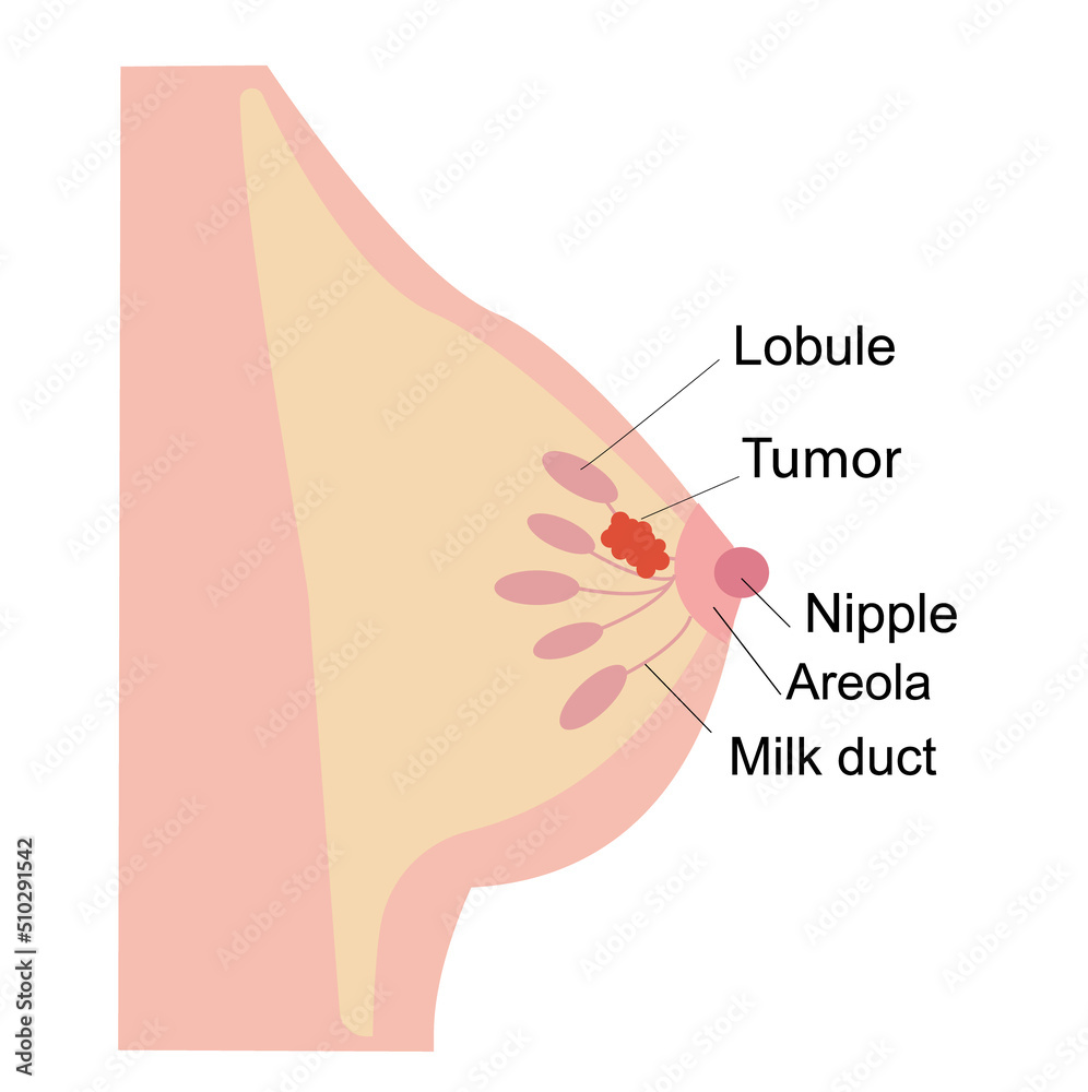 Obraz premium Infographic, medical flat illustration of female breast cancer. A tumor or neoplasm in the human chest. Anatomy of the nipple, lobule, duct and in female silhouette. Illustration for clinic, education