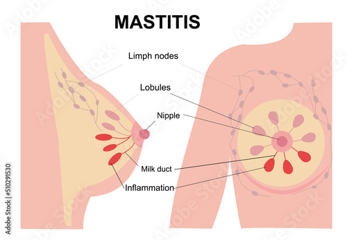 Infographic, medical flat illustration of mastitis and female breast disease concept.  Pain and inflammation in woman chest. Anatomy of the nipple, lobule, duct and in female silhouette. 