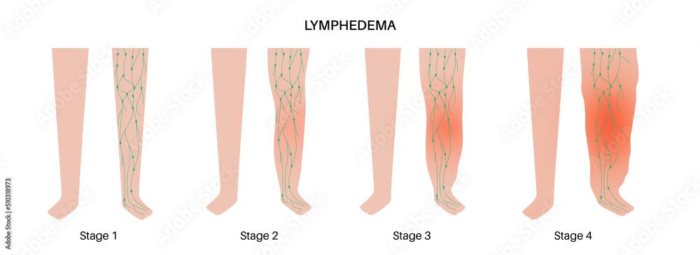 Lymphwasser Läuft Aus Den Beinen www.europosters.de