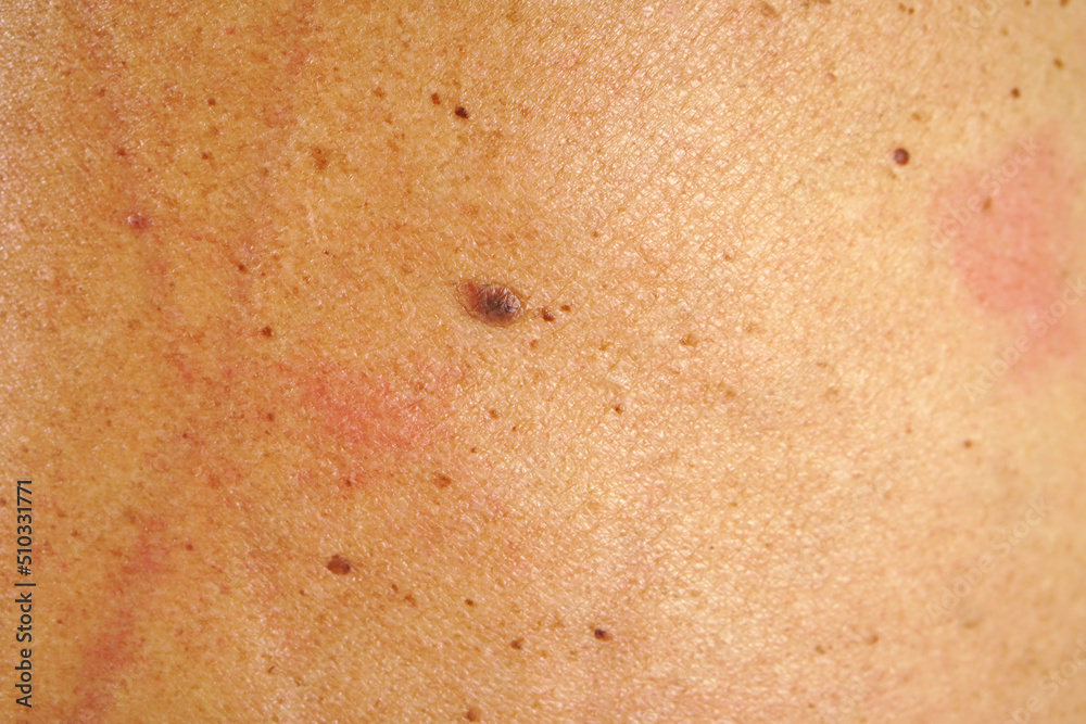 Moles on the back of human skin