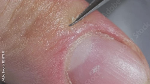 Removing of the hangnails using the scissors. photo