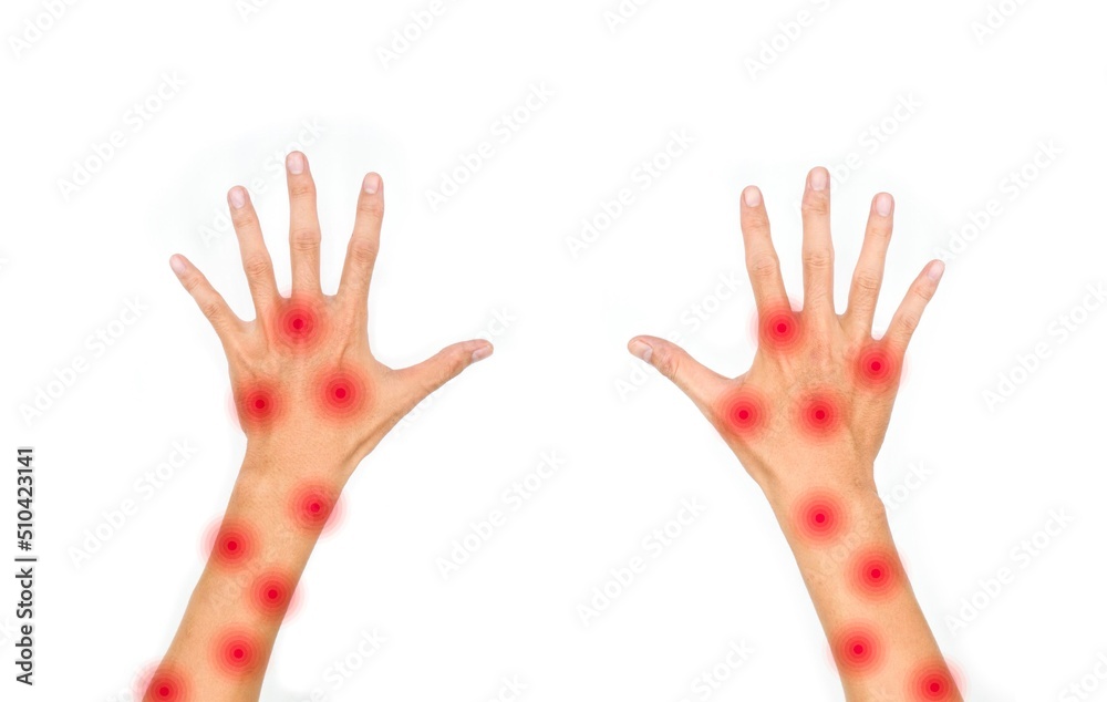 Monkeypox skin rashes over both arms of Asian young man. Monkeypox skin rashes over both arms of Asian young man.