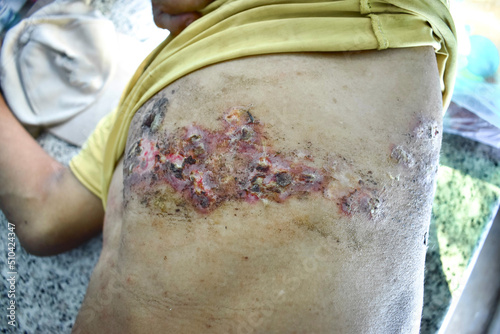 Herpes simplex infection at chest and abdomen. photo