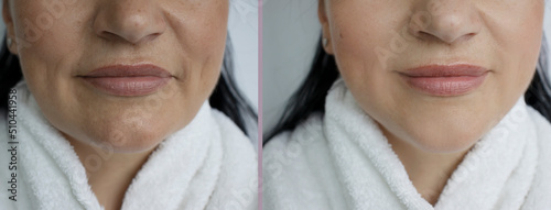 Quadro su tela Woman double chin before and after treatment