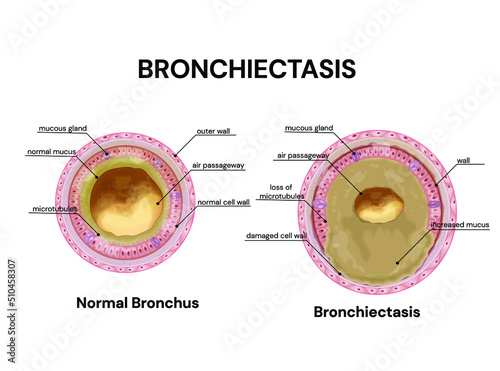 Bronchiectasis. lung disease. Normal bronchus and bronchiectasis.Vector medical illustration. photo