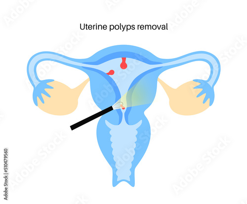 uterine polyp endometrial