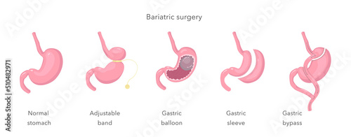 Methods of weight loss operation. Bariatric surgery. Human anatomy illustration for infographics, atlas, textbook or study material.