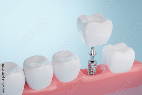 Dental implant with healthy tooth and gums, Dental crown and bridge treatment concept. 3D rendering