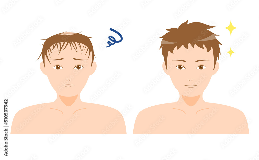 AGA 薄毛 脱毛症 男性 ビフォーアフター AGA 薄毛 脱毛症 男性 ビフォーアフター